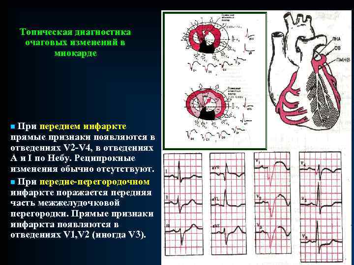 Топическая диагностика очаговых изменений в миокарде n При переднем инфаркте прямые признаки появляются в