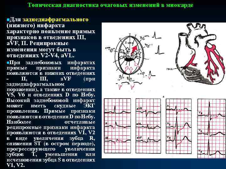 Топическая диагностика очаговых изменений в миокарде n. Для заднедиафрагмального (нижнего) инфаркта характерно появление прямых