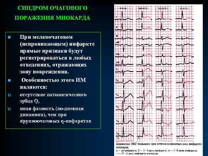 СИНДРОМ ОЧАГОВОГО ПОРАЖЕНИЯ МИОКАРДА n n 1) 2) При мелкоочаговом (непроникающем) инфаркте прямые признаки