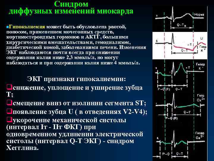 Изменения на экг что значит. Диффузные изменения миокарда левого желудочка на ЭКГ. Изменения миокарда левого желудочка на ЭКГ. Диффузное поражение миокарда ЭКГ. Метаболические изменения миокарда ЭКГ критерии.