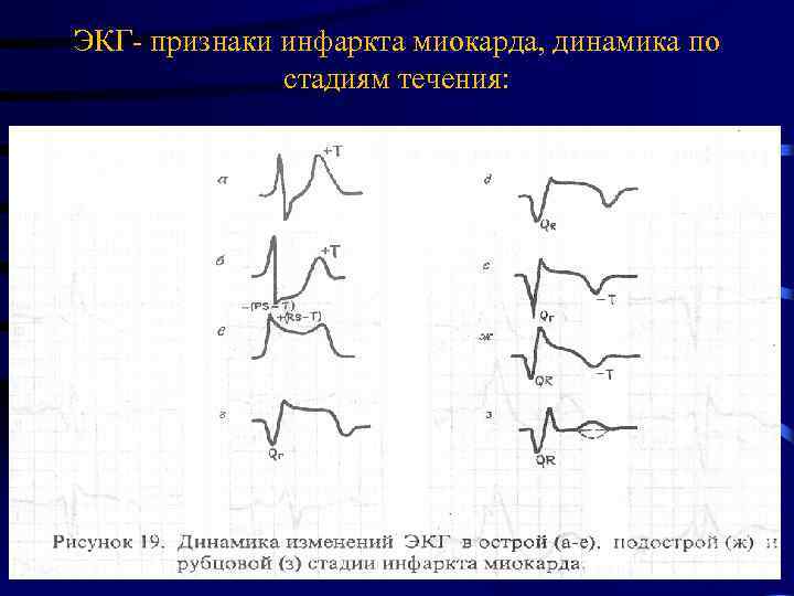 ЭКГ- признаки инфаркта миокарда, динамика по стадиям течения: 