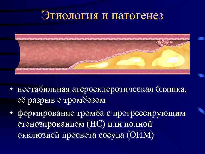 Стабильная атеросклеротическая бляшка