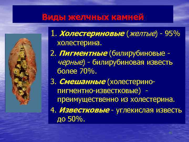 Виды желчных камней 1. Холестериновые (желтые) - 95% холестерина. 2. Пигментные (билирубиновые - черные)