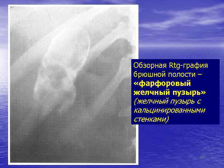 Обзорная Rtg-графия брюшной полости – «фарфоровый желчный пузырь» (желчный пузырь с кальцинированными стенками) 82