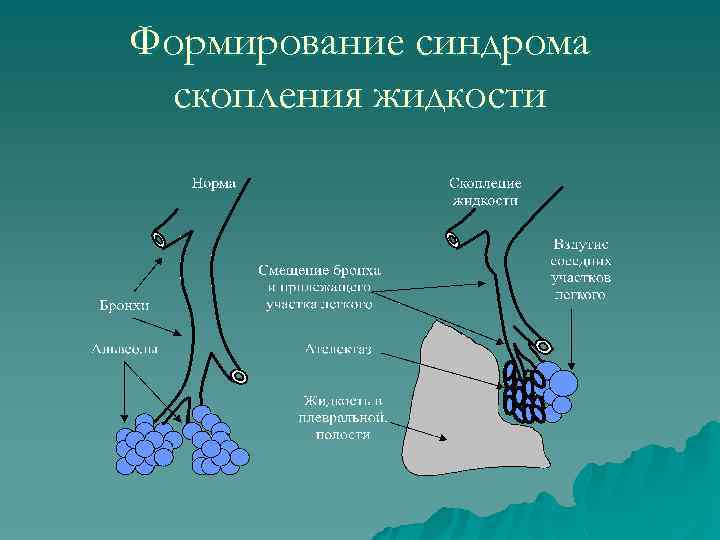 Формирование синдрома скопления жидкости 