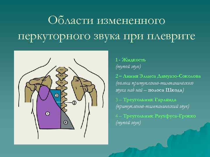 Области измененного перкуторного звука при плеврите 1 - Жидкость (тупой звук) 2 – Линия