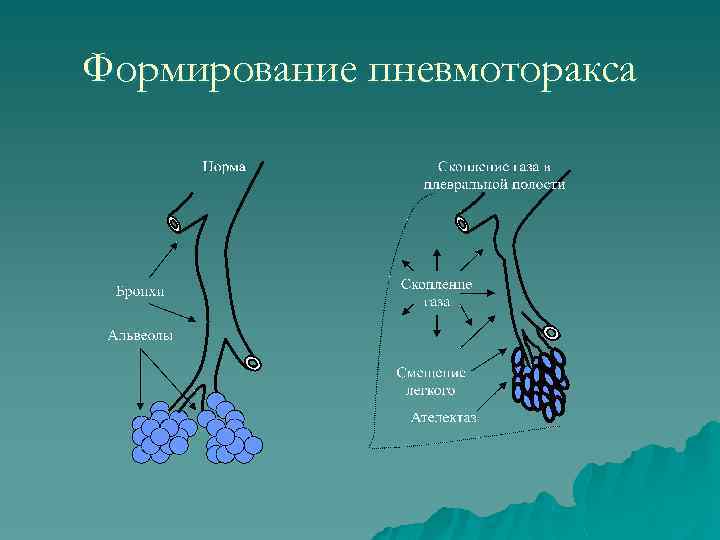 Формирование пневмоторакса 