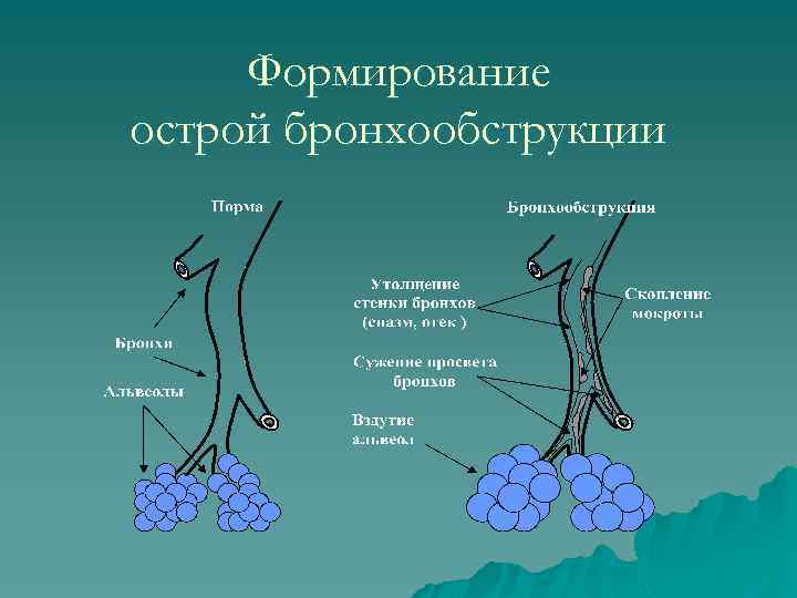 Формирование острой бронхообструкции 