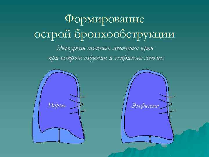 Формирование острой бронхообструкции Экскурсия нижнего легочного края при остром вздутии и эмфиземе легких Норма