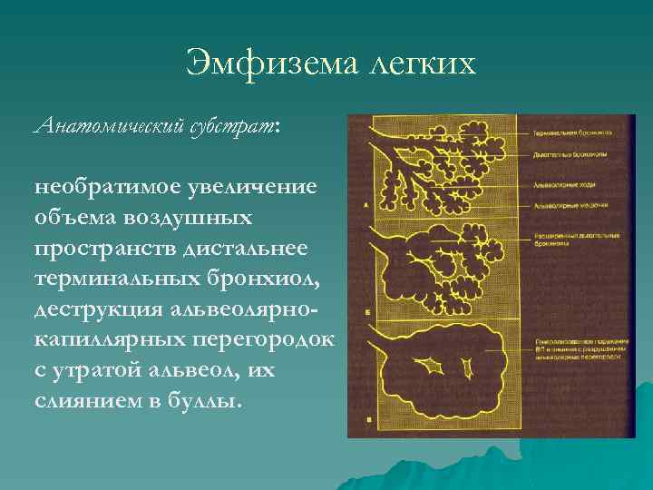 Эмфизема легких Анатомический субстрат: необратимое увеличение объема воздушных пространств дистальнее терминальных бронхиол, деструкция альвеолярнокапиллярных