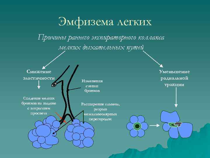 Эмфизема легких Причины раннего экспираторного коллапса мелких дыхательных путей Снижение эластичности Спадение мелких бронхов