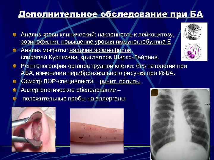 Дополнительное обследование при БА Анализ крови клинический: наклонность к лейкоцитозу, эозинофилия. повышение уровня иммуноглобулина