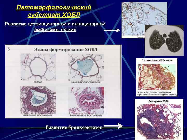 Патоморфологический субстрат ХОБЛ Развитие цетриацинарной и панацинарной эмфиземы легких Развитие бронхоэктазов 