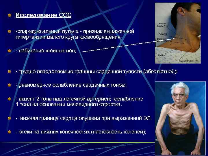 Исследование ССС - «парадоксальный пульс» - признак выраженной гипертензии малого круга кровообращения; - набухание