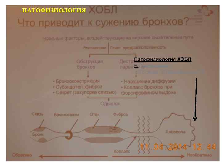 ПАТОФИЗИОЛОГИЯ Патофизиология ХОБЛ = Обструкция + легочная гиперинфляция !!! 