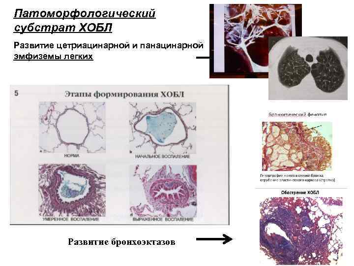 Патоморфологический субстрат ХОБЛ Развитие цетриацинарной и панацинарной эмфиземы легких Развитие бронхоэктазов 