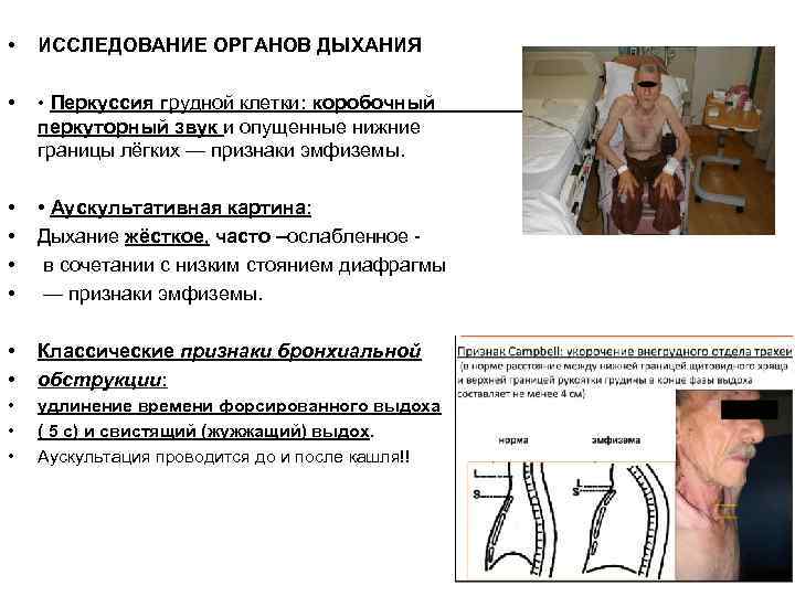  • ИССЛЕДОВАНИЕ ОРГАНОВ ДЫХАНИЯ • • Перкуссия грудной клетки: коробочный перкуторный звук и