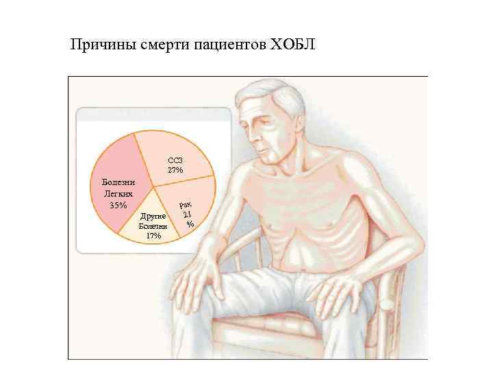 Причины смерти пациентов ХОБЛ ССЗ 27% Болезни Легких 35% Другие Болезни 17% Рак 21