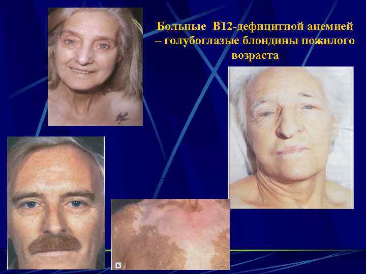Больные В 12 -дефицитной анемией – голубоглазые блондины пожилого возраста 