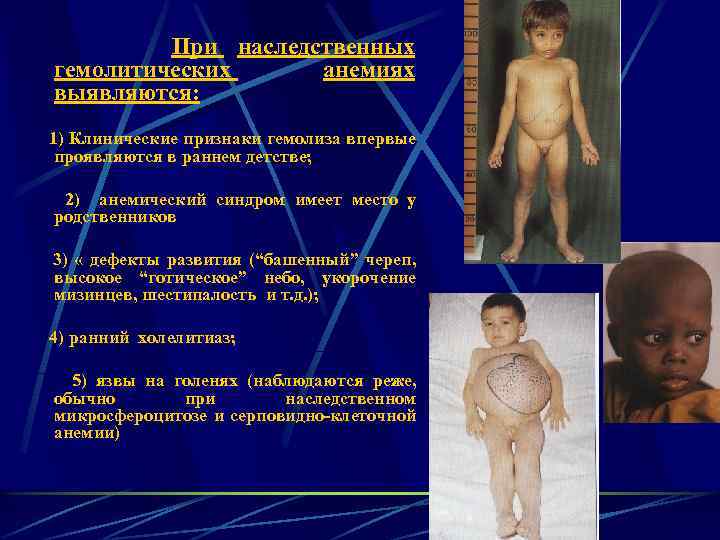 При наследственных гемолитических анемиях выявляются: 1) Клинические признаки гемолиза впервые проявляются в раннем детстве;