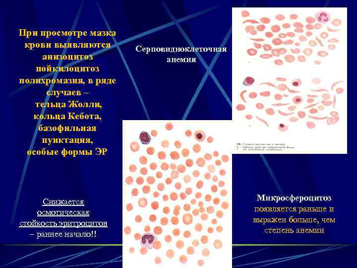 Малярия в мазке крови фото