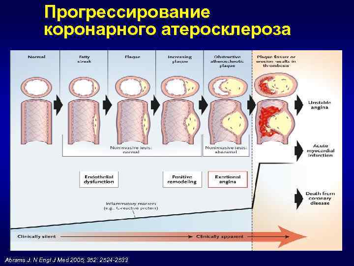 Прогрессирование коронарного атеросклероза Abrams J. N Engl J Med 2005; 352: 2524 -2533 