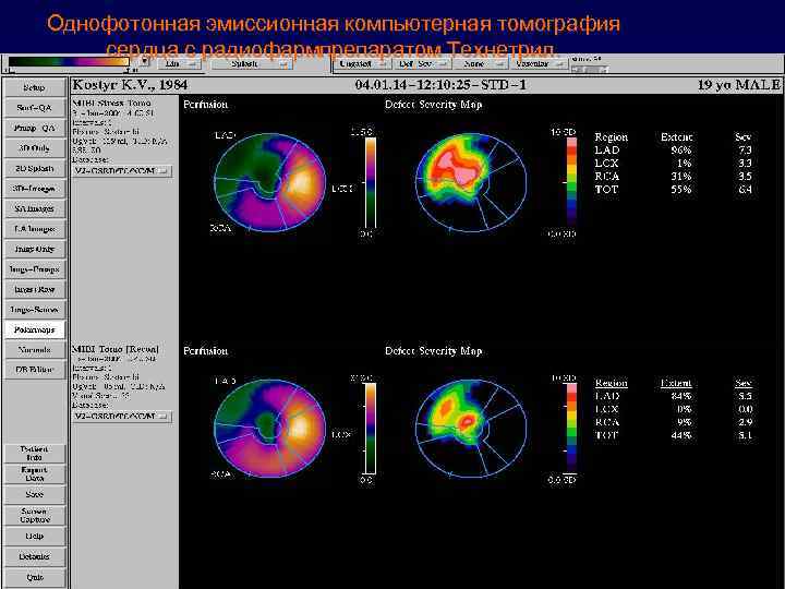 Однофотонная эмиссионная компьютерная томография сердца с радиофармпрепаратом Технетрил. 