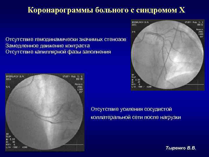 ИБС синдром х. Синдром Икс в кардиологии.