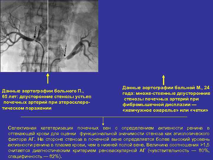Данные аортографии больного П. , 65 лет: двусторонние стенозы устьев почечных артерий при атеросклеро