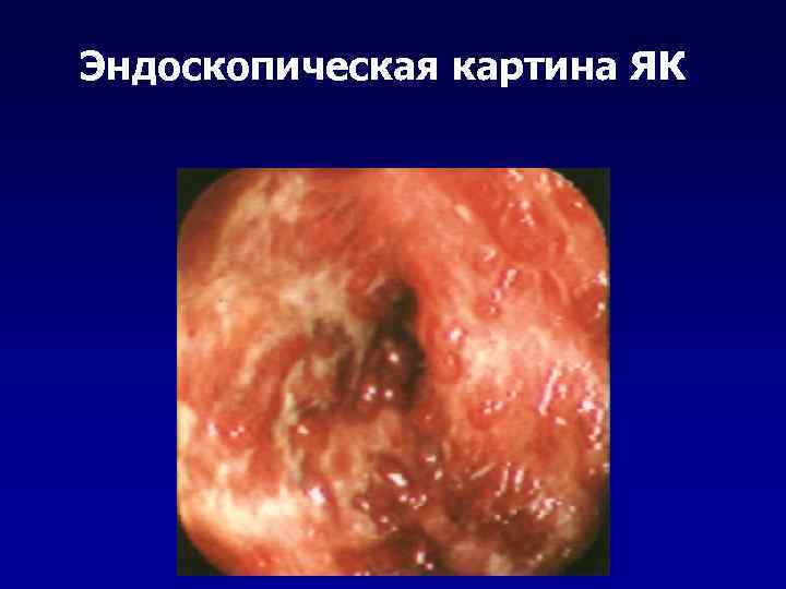 Эндоскопическая картина ЯК 