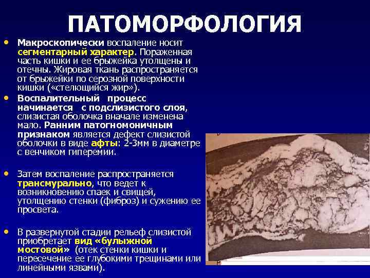 ПАТОМОРФОЛОГИЯ • Макроскопически воспаление носит • сегментарный характер. Пораженная часть кишки и ее брыжейка