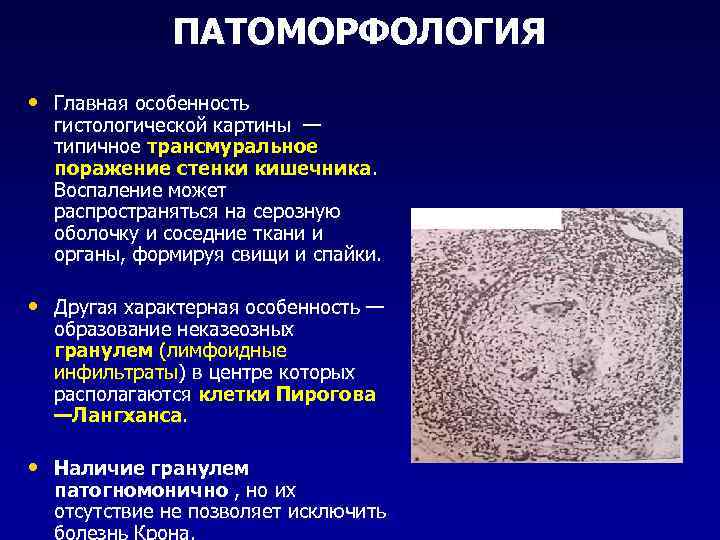 ПАТОМОРФОЛОГИЯ • Главная особенность гистологической картины — типичное трансмуральное поражение стенки кишечника. Воспаление может