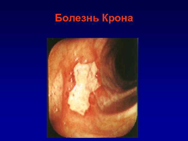 Болезнь Крона 