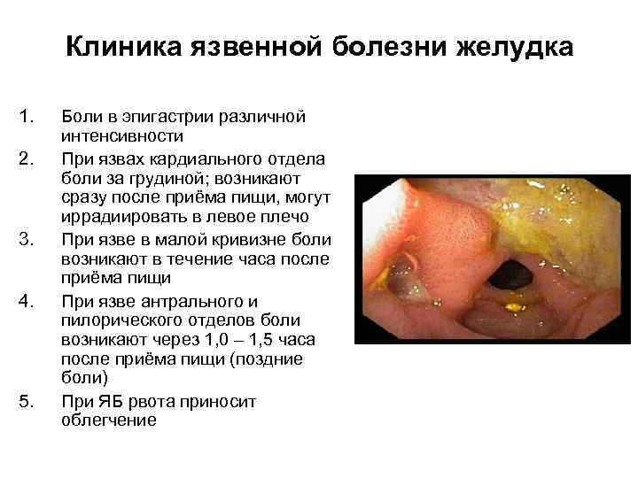 Клиника язвенной болезни желудка 1. 2. 3. 4. 5. Боли в эпигастрии различной интенсивности