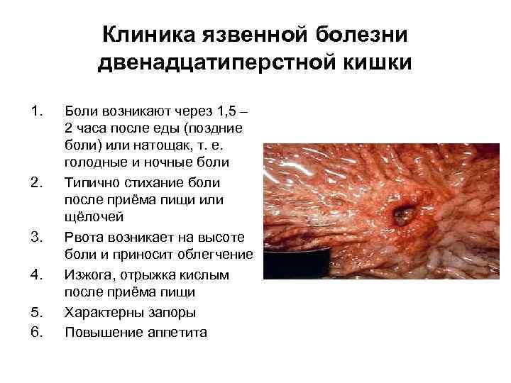 Клиника язвенной болезни двенадцатиперстной кишки 1. 2. 3. 4. 5. 6. Боли возникают через