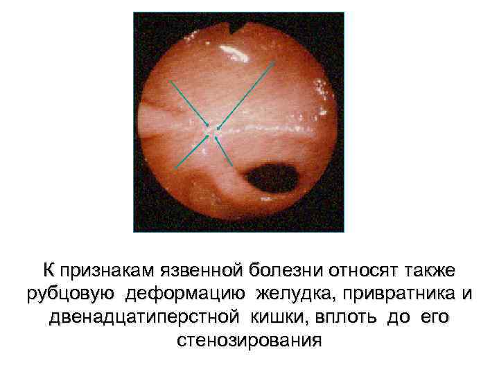 К признакам язвенной болезни относят также рубцовую деформацию желудка, привратника и двенадцатиперстной кишки, вплоть