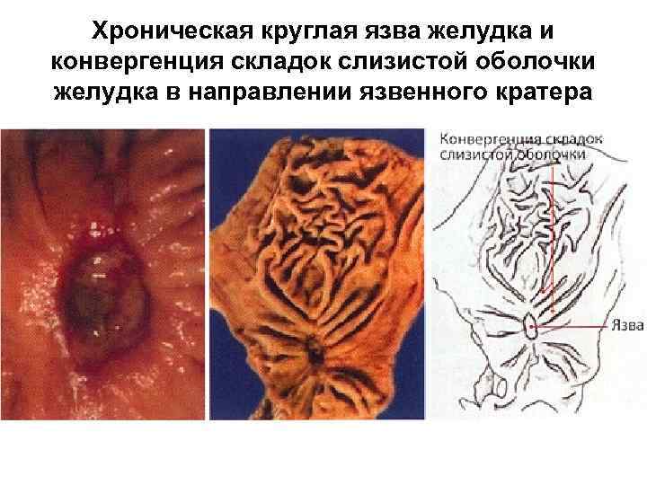 Хроническая круглая язва желудка и конвергенция складок слизистой оболочки желудка в направлении язвенного кратера