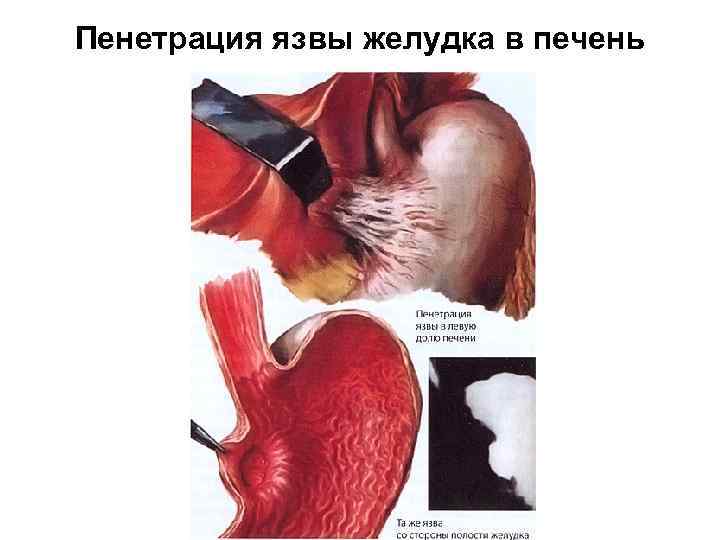 Пенетрация язвы желудка в печень 