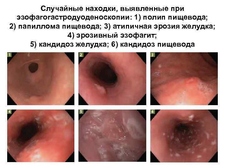 Случайные находки, выявленные при эзофагогастродуоденоскопии: 1) полип пищевода; 2) папиллома пищевода; 3) атипичная эрозия