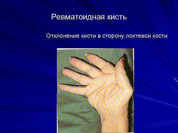 Ревматоидная кисть Отклонение кисти в сторону локтевой кости 