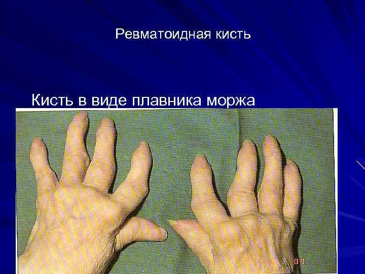 Ревматоидная кисть Кисть в виде плавника моржа 
