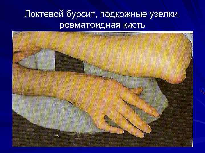 Локтевой бурсит, подкожные узелки, ревматоидная кисть 