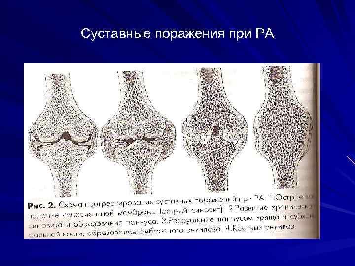 Суставные поражения при РА 