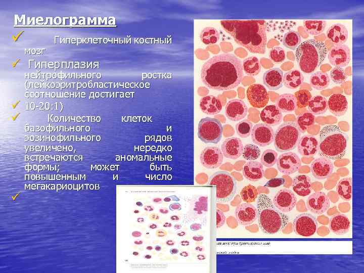 Миелограмма ü Гиперклеточный костный ü ü мозг Гиперплазия нейтрофильного ростка (лейкоэритробластическое соотношение достигает 10