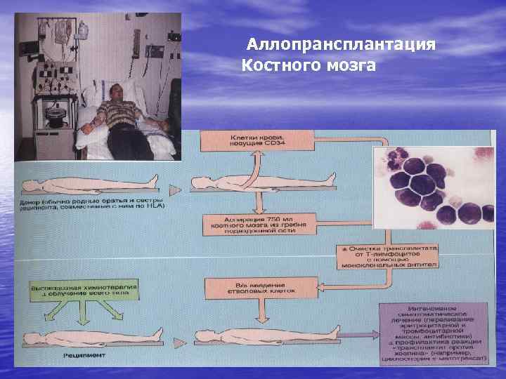 Аллопрансплантация Костного мозга 