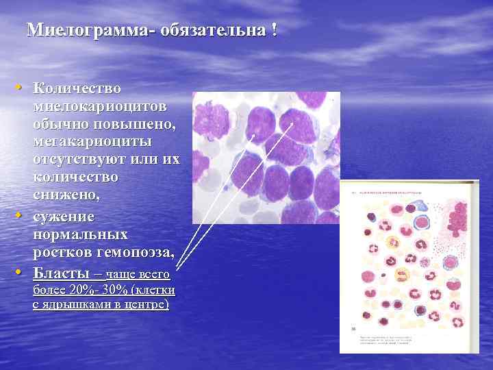 Миелограмма- обязательна ! • Количество • • миелокариоцитов обычно повышено, мегакариоциты отсутствуют или их