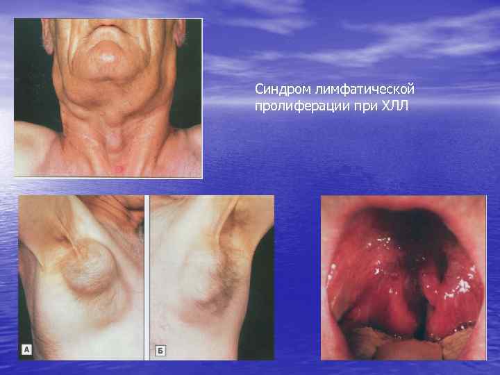 Синдром лимфатической пролиферации при ХЛЛ 