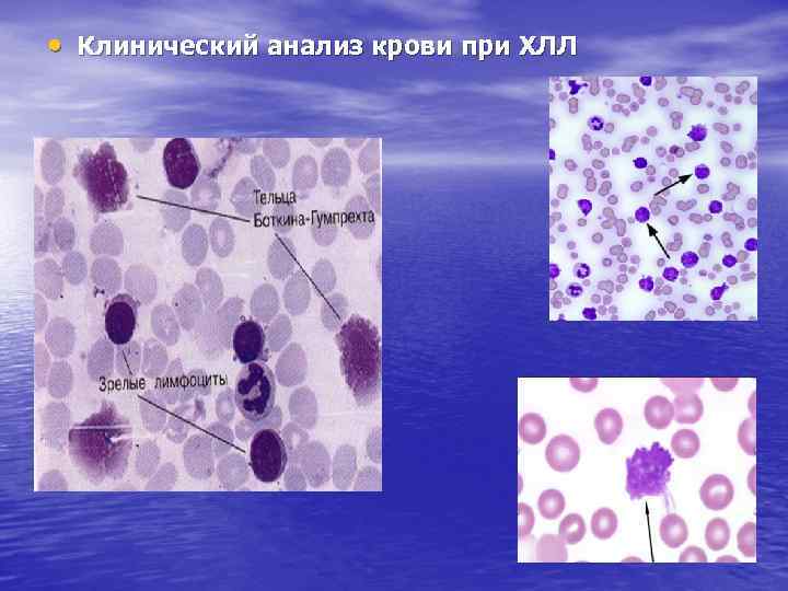  • Клинический анализ крови при ХЛЛ 