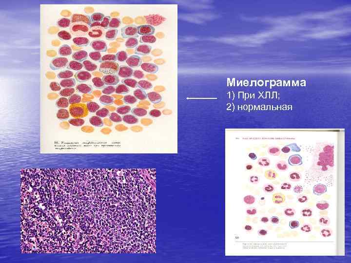 Миелограмма 1) При ХЛЛ; 2) нормальная 