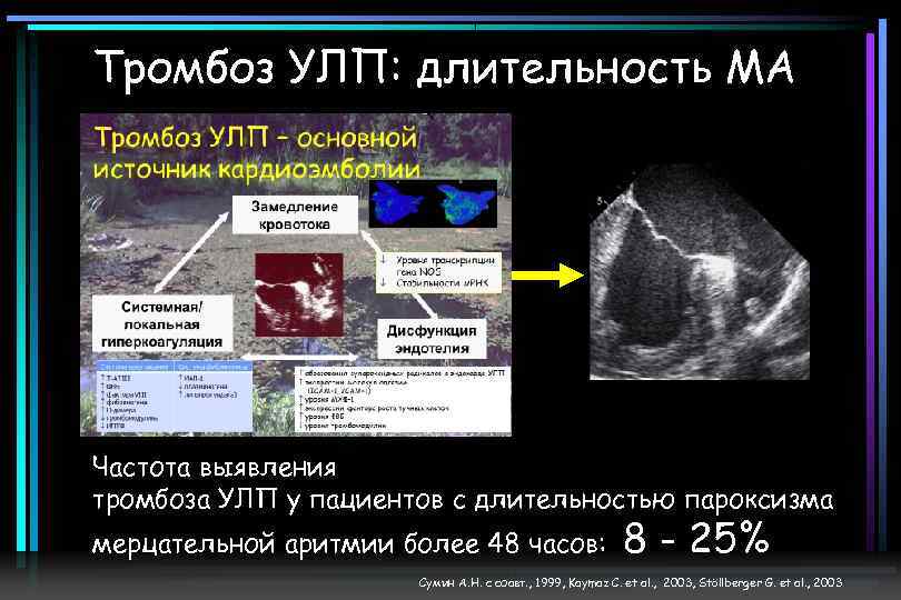 Тромбоз УЛП: длительность МА Частота выявления тромбоза УЛП у пациентов с длительностью пароксизма мерцательной